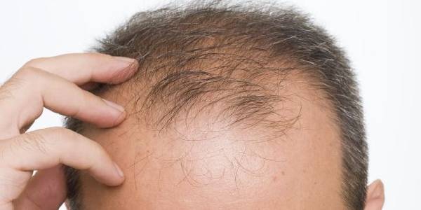 Hormones and Hairloss - Causes Preventions !