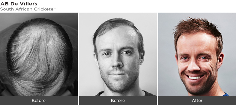 Hair Fall Hair Regrowth Clinic Hair Loss Clinic In Dubai Ahs Uae