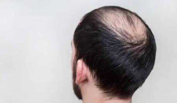 Let’s take a look at different races and the varying likelihoods of baldness