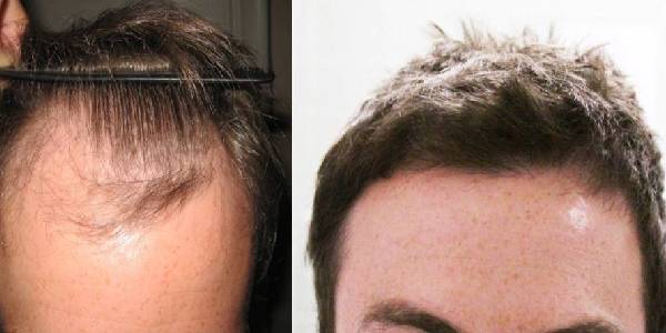 7 TIPS TO KEEP IN MIND WHILE SEARCHING FOR A HAIR REGROWTH CLINIC