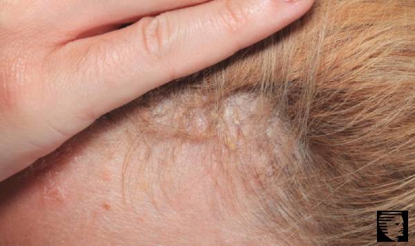 Can A Burning Scalp Lead To Hair Loss Uae