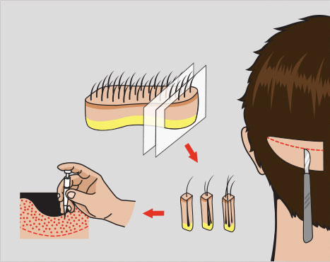 Ultimate Guide for Hair Transplant Cost Procedure Pre & Post Care UAE