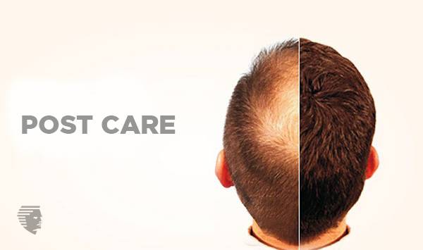 Ultimate Guide for Hair Transplant Cost Procedure Pre & Post Care UAE