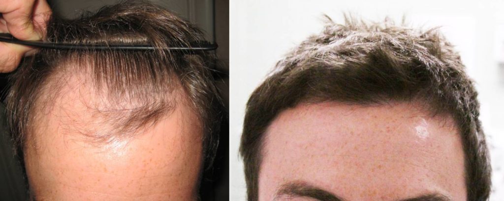 7 TIPS TO KEEP IN MIND WHILE SEARCHING FOR A HAIR REGROWTH CLINIC