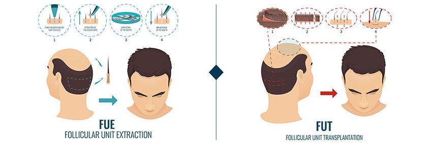 EVERYTHING YOU WANTED TO KNOW ABOUT HAIR TRANSPLANT