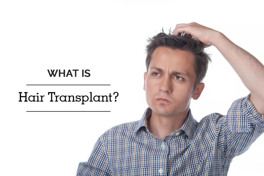 EVERYTHING YOU WANTED TO KNOW ABOUT HAIR TRANSPLANT