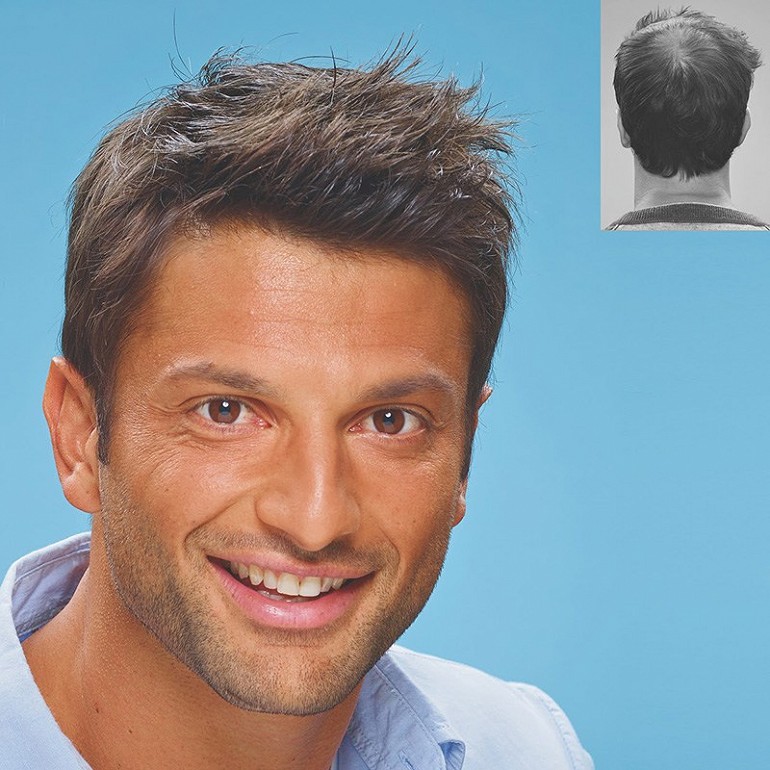 Hair transplant cost in dubai 1