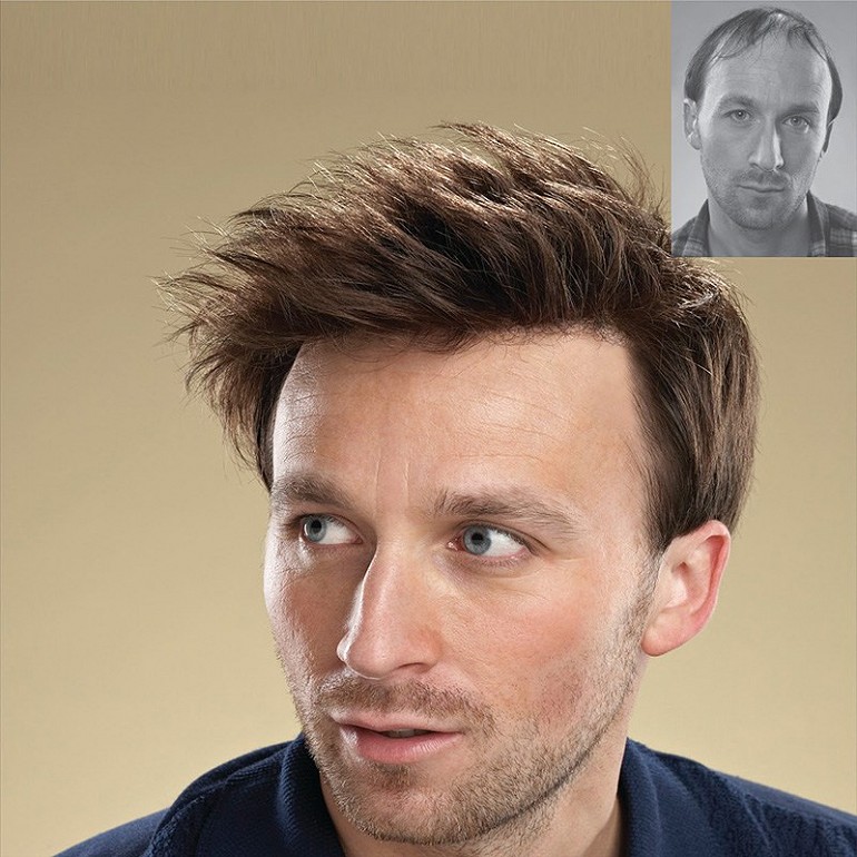 Hair transplant cost in dubai 2