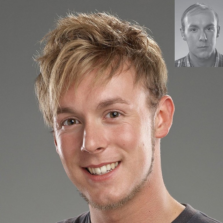 Hair transplant cost in dubai 3