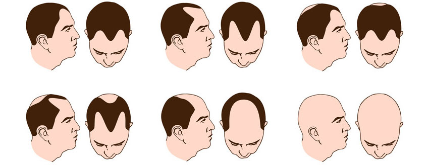 Male Pattern Baldness