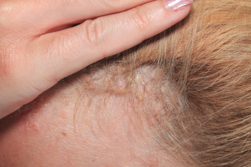 Can A Burning Scalp Lead To Hair Loss Uae